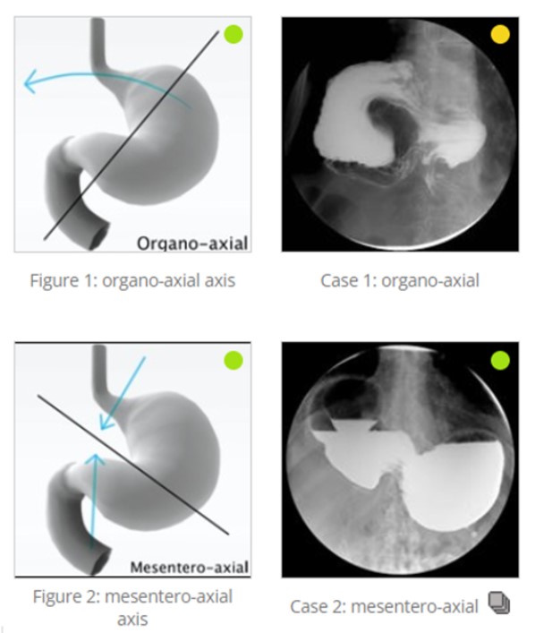 Imagem 1: Ornagoaxial / Caso 1: organoaxial / Figura 2: mesenteroaxial / Caso 2: Mesenteroaxial. Jones, J., Vadera, S. Gastric volvulus. 