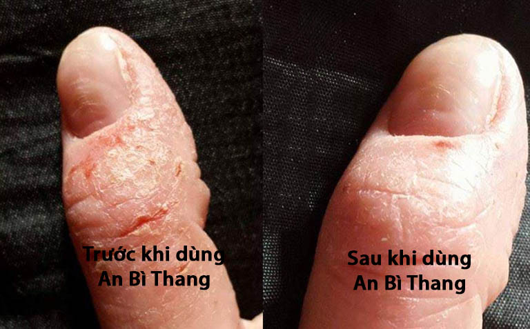 Hiệu quả sử dụng bài thuốc An Bì Thang (Ảnh: NVCC)