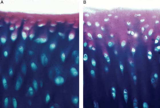 (A) Typical articular cartilage and a sample of (B) articular cartilage after a period of experimentally-induced synovitis without traumatic injury or instability.