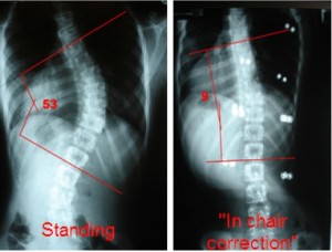 The Scoliosis Traction Chair: Can It Really Help?