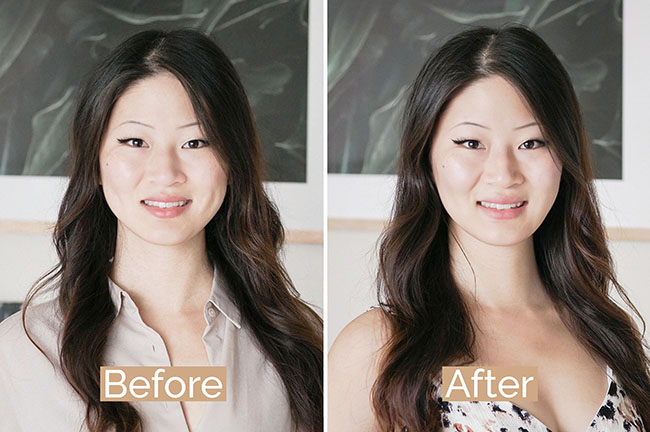 How Much Is Botox For Tmj