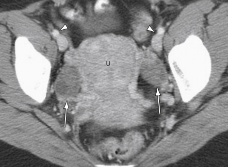 Aspecto tomográfico normal dos ovários (setas) e do  útero (U). As cabeças de setas mostram os vasos ilíacos externos. 