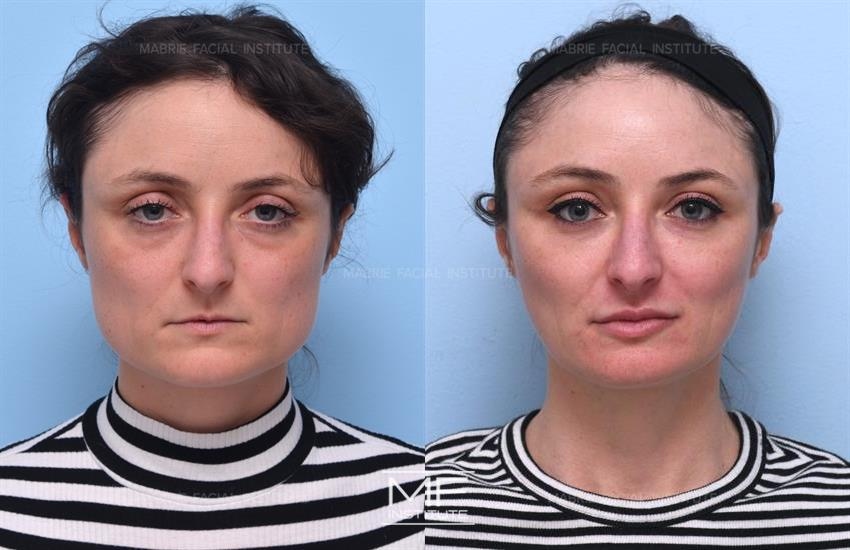 Before and after picture of botox for this lady