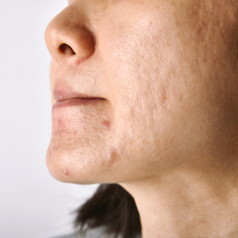 How to reduce blemishes