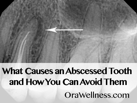 What Causes an Abscessed Tooth and How You Can Avoid Them