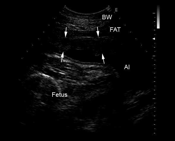 Abnormal appearance of uteroplacental unit showing increased thickness, placental edema and folding consistent with placentitis