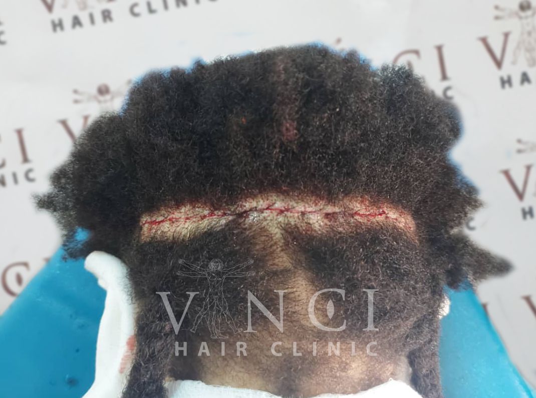 hair restoration: A client showing her scar following an FUT procedure at Vinci Hair Clinic