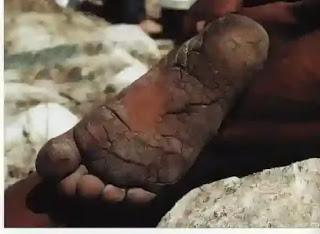 फटी एड़ियों का इलाज करने के घरेलू उपाय