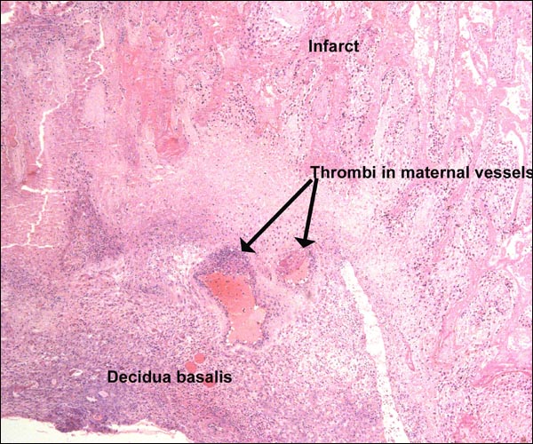 Infarcted placenta of Liontailed macac with thrombosis of decidual blood vessels