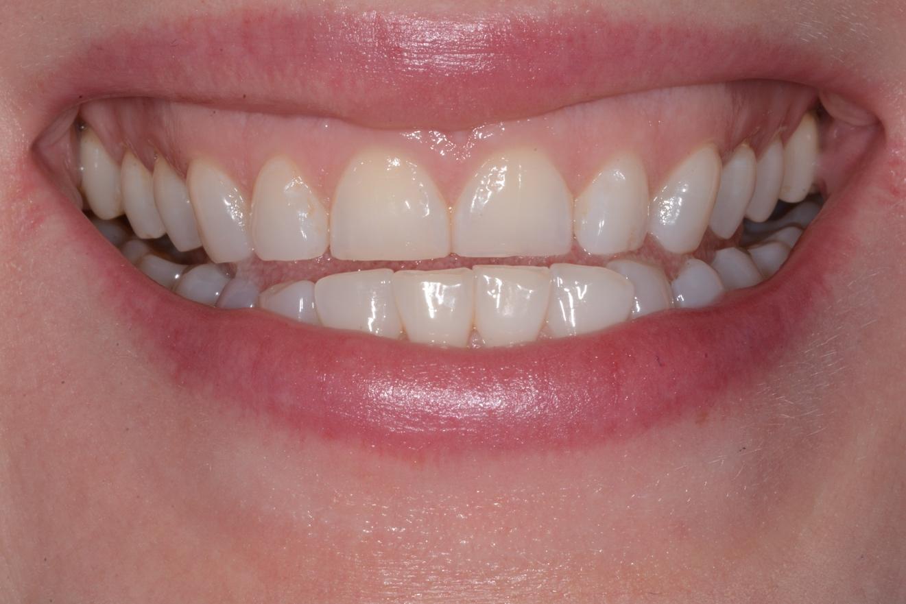 A close up of a person's mouth  Description automatically generated with medium confidence