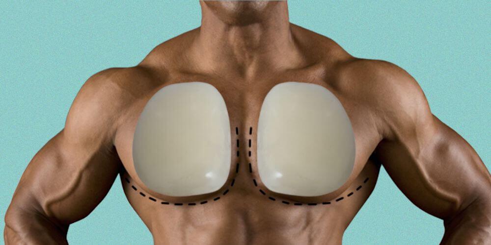 Image des implants pectoraux