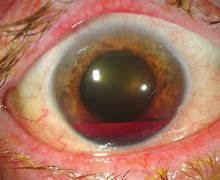 penyakit pada pupil mata - hyphema