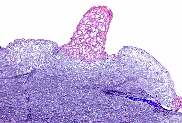 The surfaces of the umbilical cords have fine granules of squamous metaplasia