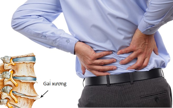 Bệnh gai cột sống gây đau vừng thắt lưng, vai hoặc gây tê tay