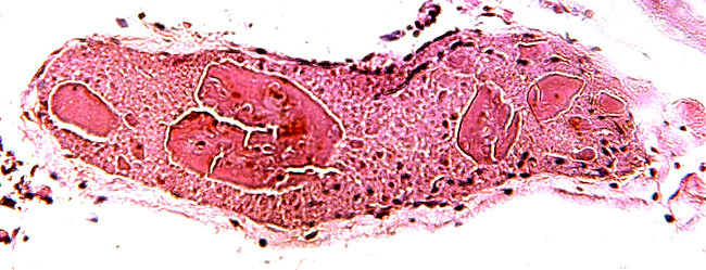 Another 'chorionic vesicle' with peculiar inclusions