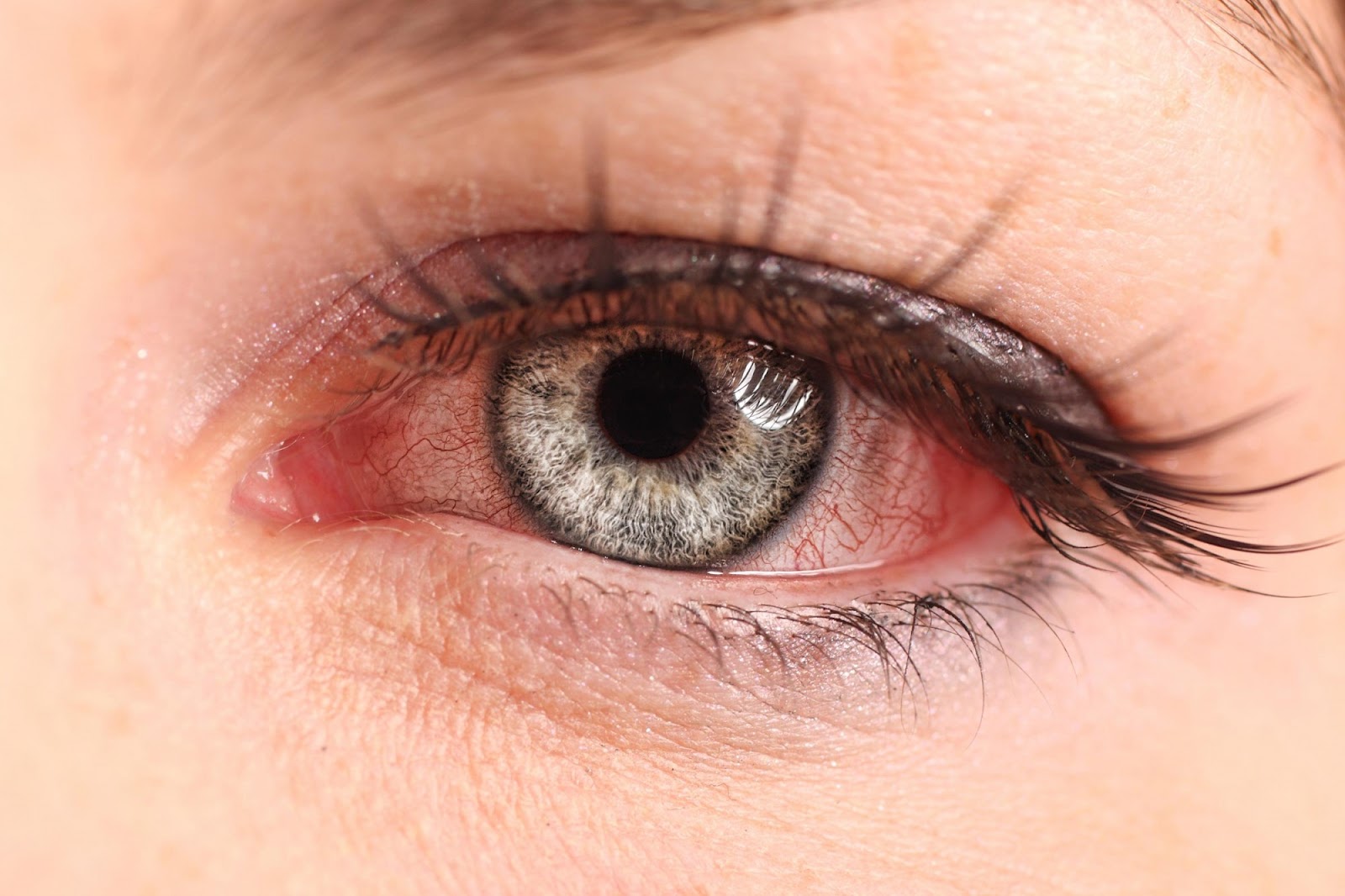 Tác dụng phụ của thuốc nhỏ mắt Vigamox là có thể gây kích ứng mắt
