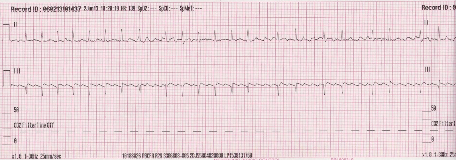 flutter atrial con respuesta ventricular variable