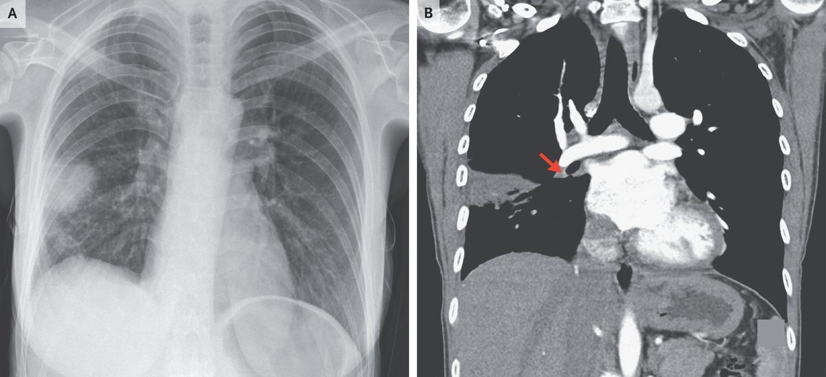 Hampton's Hump | NEJM