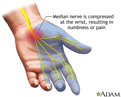 Hand pain while gaming could be due to carpal tunnel syndrome.