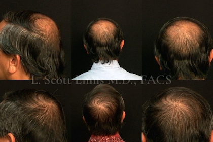 neograft hair transplant reddit