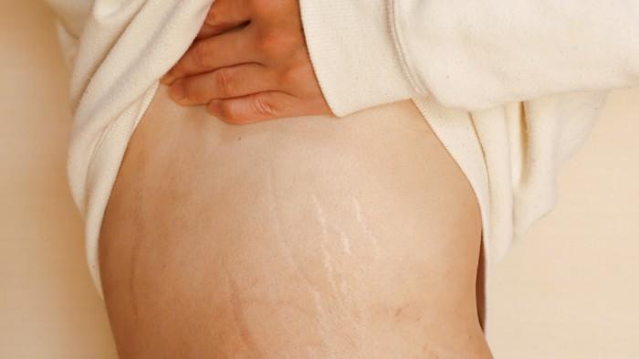 Stretch Marks: What Are They and How to Treat Them