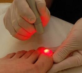Red light being used to treat toenail fungus