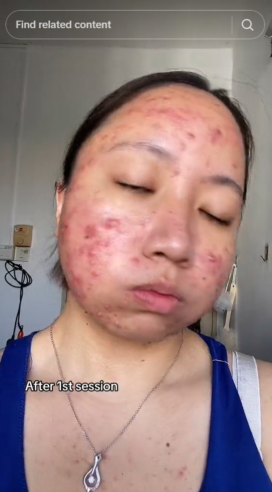 A screenshot of a social media post showing a girl who looks like she got dermatology session