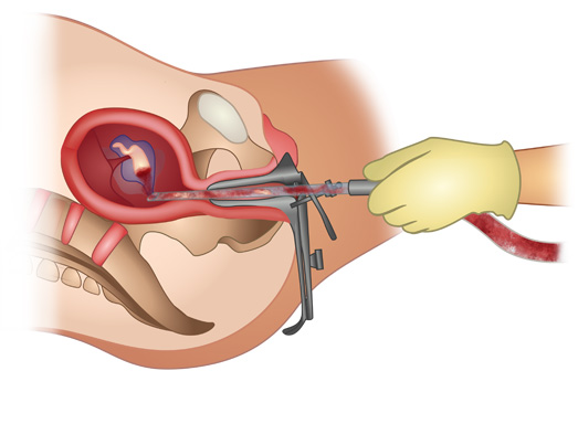 Phá thai không đau ở Cầu Giấy bằng phương pháp sử dụng ống hút trực quan siêu dẫn