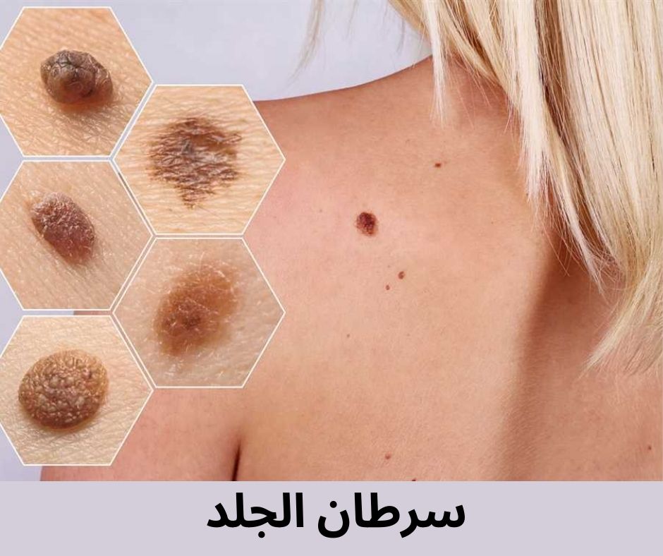 سرطان الجلد skin cancer وأهم أسبابه وطرق العلاج - توعية