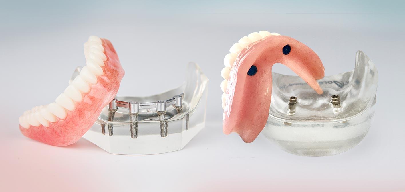 Richmond Hill dental implants