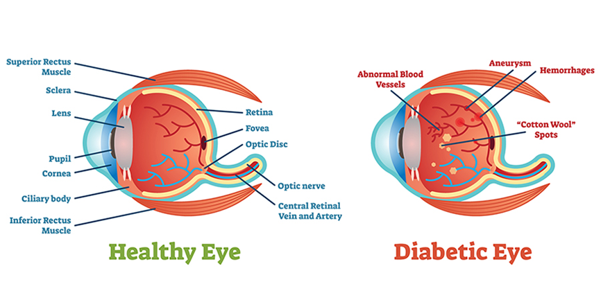 Healthy eye vs Diabetic Eye