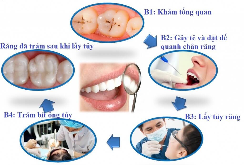 Quy trình điều trị tủy răng nhanh chóng