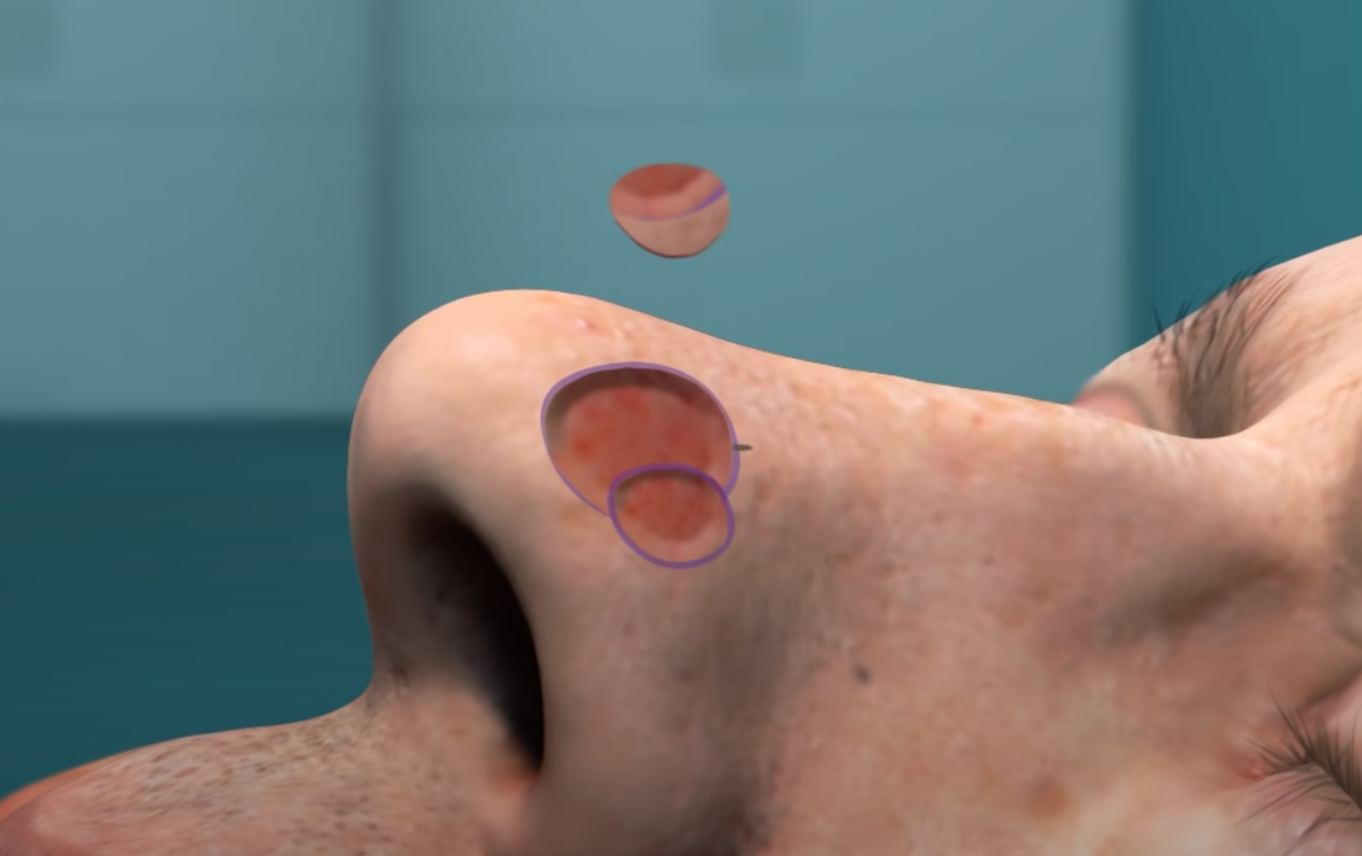 ampliaçao de margens cirurgicas, na cirurgia de mohs no cancer de pele