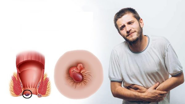dược phẩm trị trĩ nội