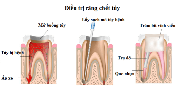 Viêm tủy răng cần được điều trị sớm