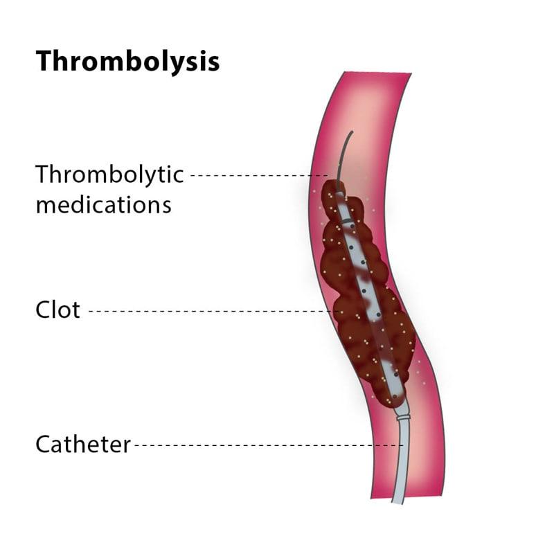 Know What is Thrombolytic Therapy and its Uses,Side effects