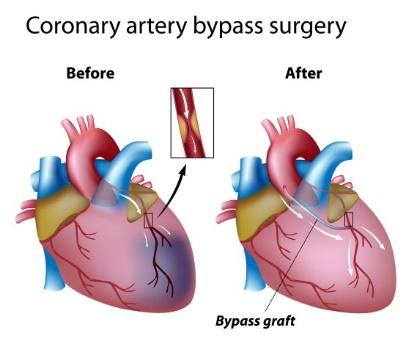 bypass surgery (CABG)