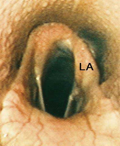 Idiopathic, complete paralysis of the left arytenoid cartilage (LA).
