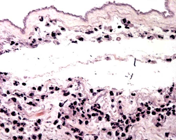 Marginal membranes with acute chorioamnionitis.