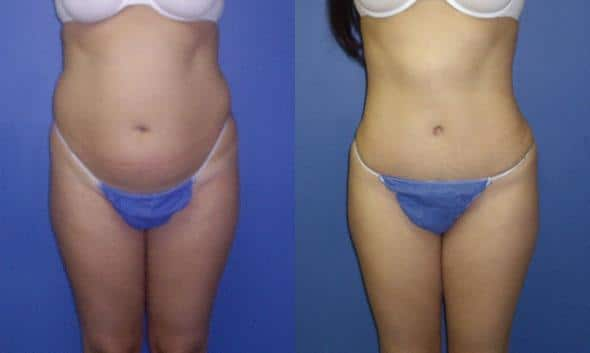 liposuction and tummy tuck results