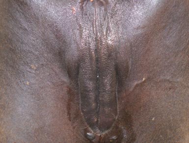 The external genitals of a buffalo. (Photo Courtesy Prof G.N. Purohit, Department of Veterinary Gynecology and Obstetrics, College of Veterinary and Animal Sciences, Bikaner Rajasthan, India).