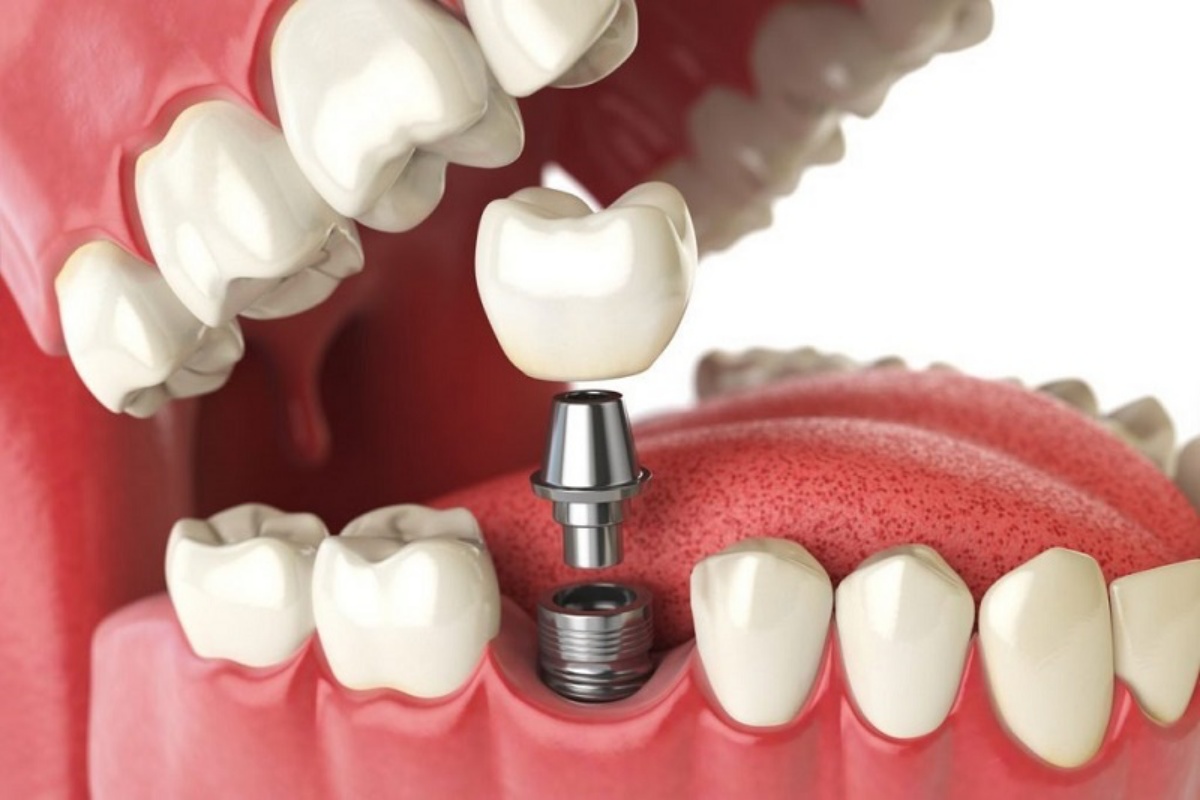 Implant Mỹ có khả năng tích hợp xương hàm nhanh chóng