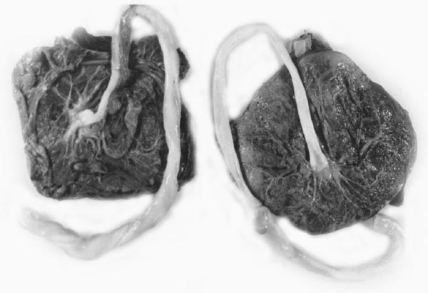 Mature twin placentas of hybrid orangutan neonates. There are two separate disks, fetal side, and maternal side