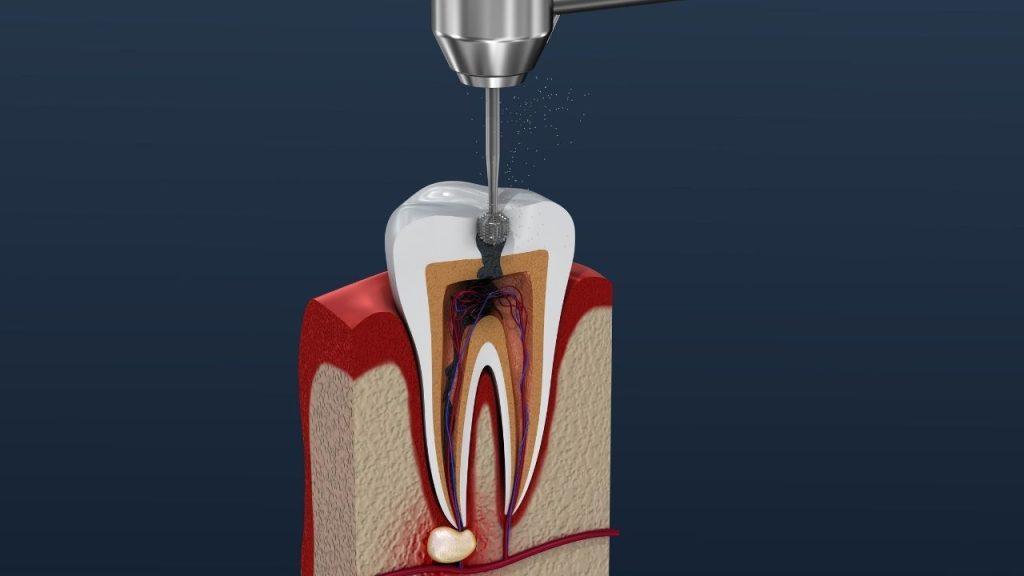 root canal treatment image