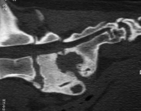 Sagittal computed tomographic reconstruction of a lumbosacral discospondylitis in a dog