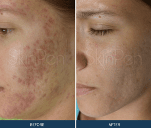 Laser Treatment for Acne Scarring | Advanced Dermatology Midlands