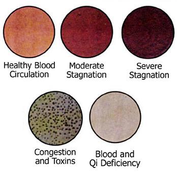 Image result for cupping after