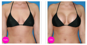 nâng ngực nội soi hình ảnh trước sau thẩm mỹ viện công nghệ cao hương giang (1)