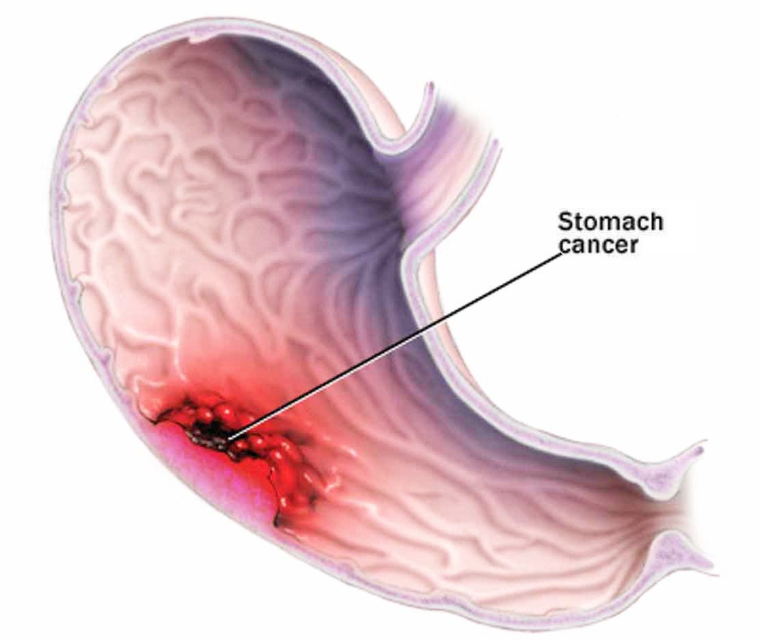 http://cancer-treatment-madurai.com/stomach-and-oesophagus-cancer.php
