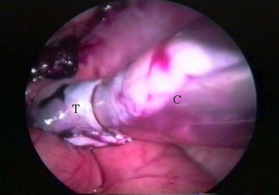 Cánula de tejido removiendo el testículo del abdomen. T: Testículo; C: Cánula de tejido.
